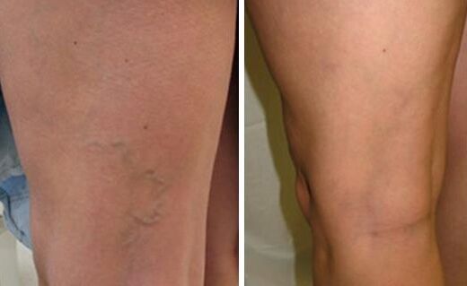 Neoveris helped prevent the development of varicose veins