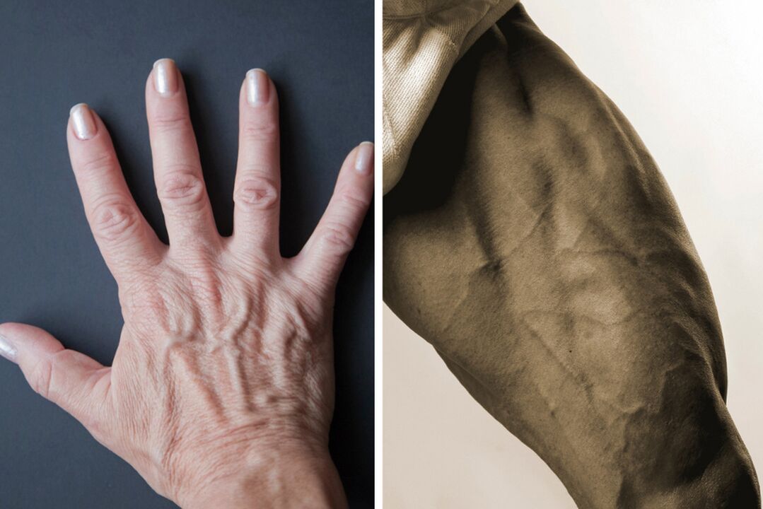 Varicose veins symptoms