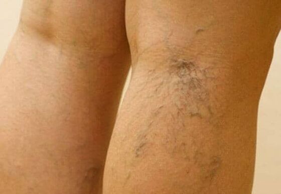 varicose veins