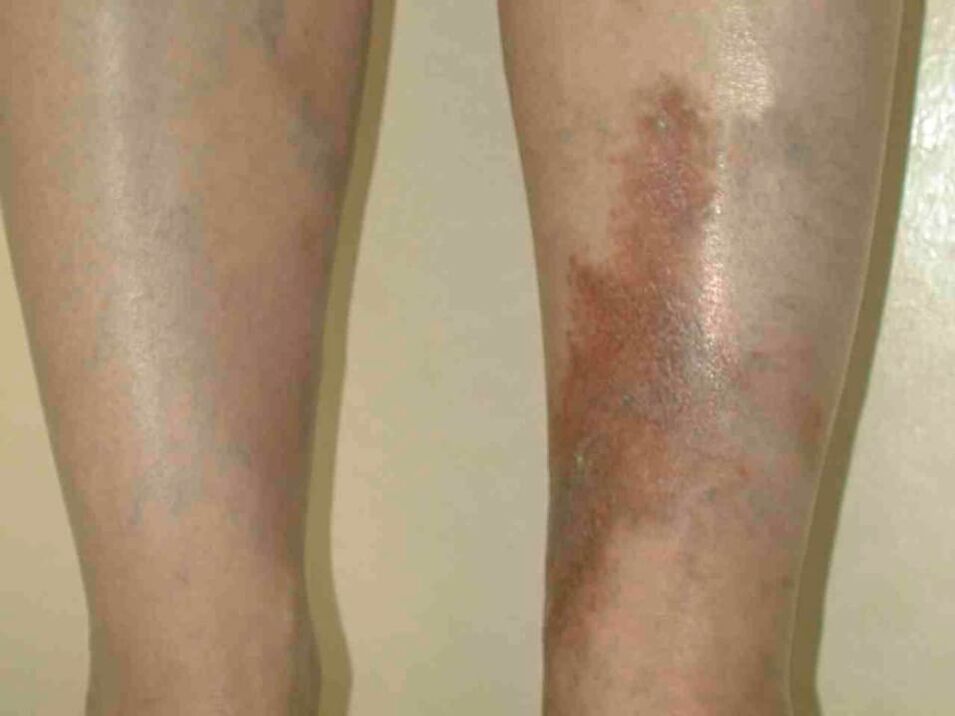 Varicose veins