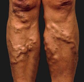 Varicose veins