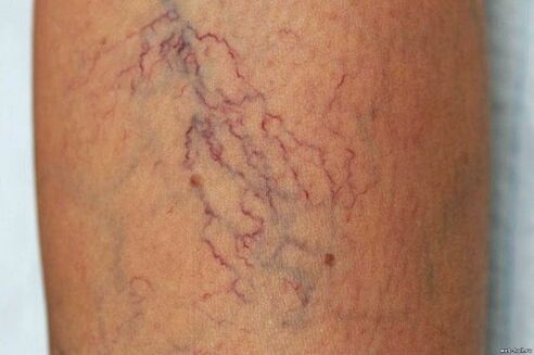 Why varicose veins are dangerous