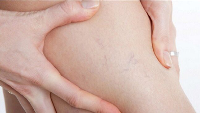 Spider veins on the legs are a sign of varicose veins