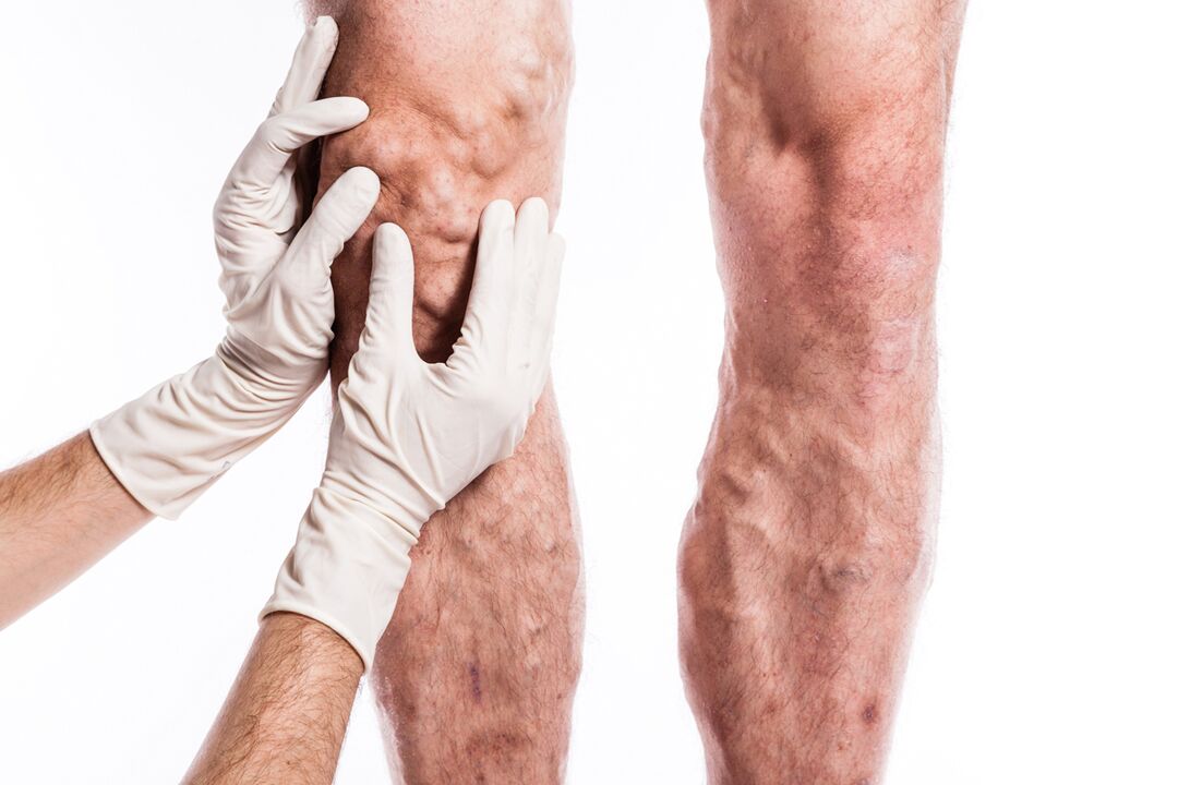 Phlebologist examines the legs of a patient with varicose veins