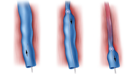 Radiofrequency ablation is a method of treating varicose veins