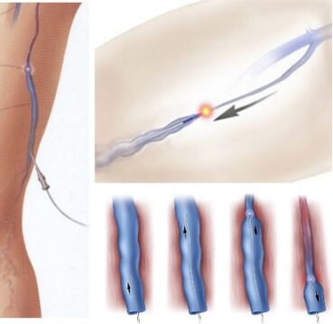 varicose vein treatment method - endovenous laser coagulation