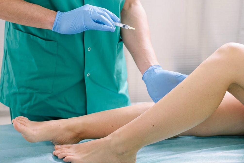 sclerotherapy for varicose vein removal