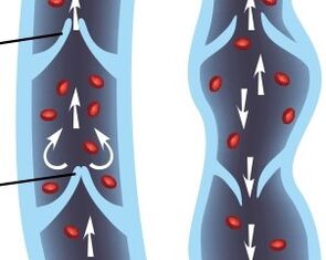 operation of the valve apparatus of the veins of the lower extremities