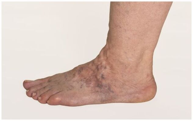 Varicose veins in a man's leg, complicated by trophic ulcers