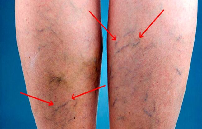 Protruding veins on legs with varicose veins