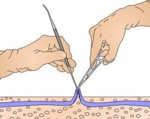 Miniphlebectomy - removal of the part of the vein affected by varicose veins