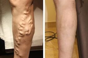 The result of the operation to eliminate varicose veins from the legs