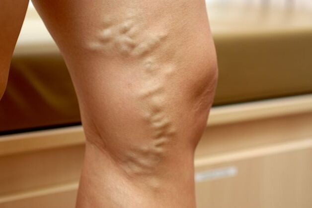 Protruding misshapen leg vein with stage 3 varicose veins