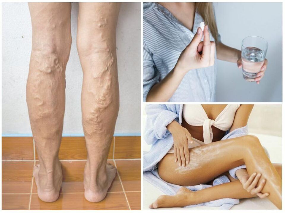 Varicose veins of the lower extremities and methods of their treatment