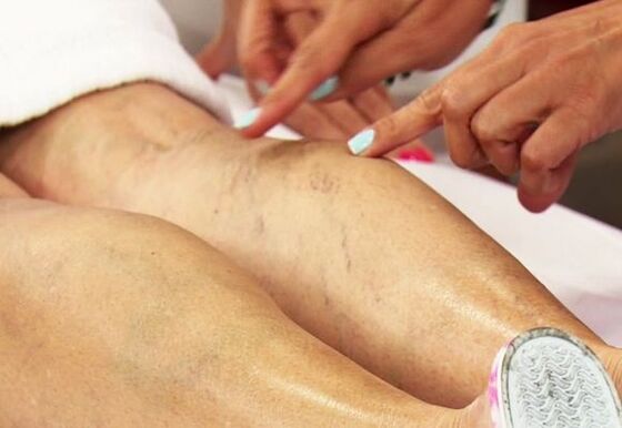 examination of legs with varicose veins in women