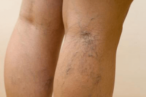 picture of varicose veins on legs